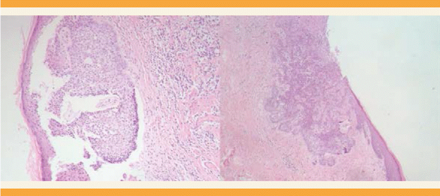 Basal cell carcinoma of the vulva: A rare presentation of a common disease