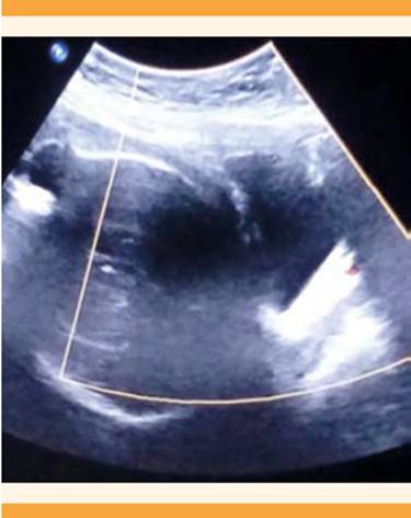
						Ultrasonograma Doppler dirigido al segmento uterino, sin incremento
							de la vascularidad.
					