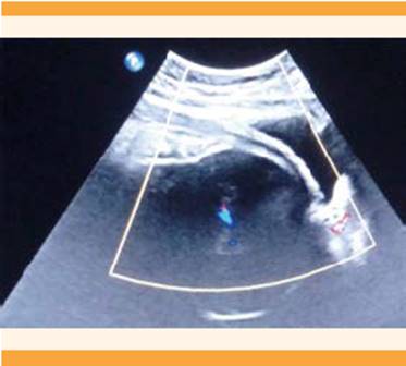 
						Ultrasonograma Doppler del segmento uterino, sin incremento en la
							vasculatura.
					