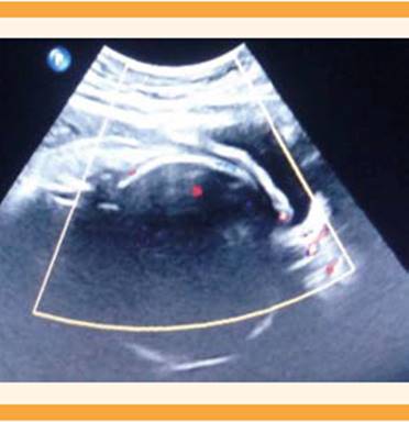 
						Ultrasonograma Doppler del segmento uterino, con vascularidad
							normal.
					