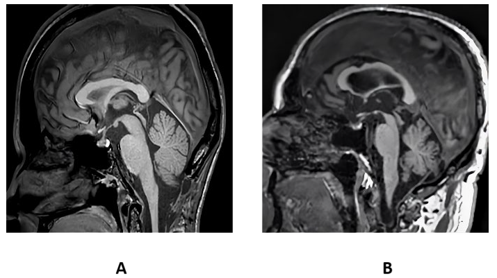 
							T1 weighted sagittal view of midbrain of a control (A) and PSP patient (B). 
						