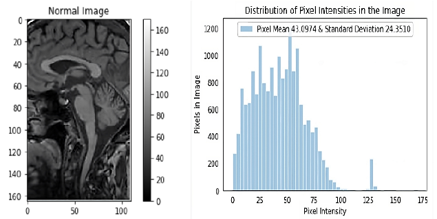 
							Depicts the input image read from the repository of that of a normal patient and displays the graph with the corresponding distribution of pixel intensity of the input image.
						