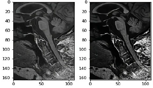 
							T1 weighted sagittal view of midbrain of a normal input image and fuzzy enhanced image.
						