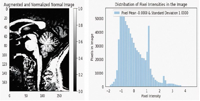 
							Depicts the input image read from the repository of that of a normal patient after being augmented, normalized, and displays the graph with the corresponding distribution of pixel intensity of the augmented, normalized image.
						