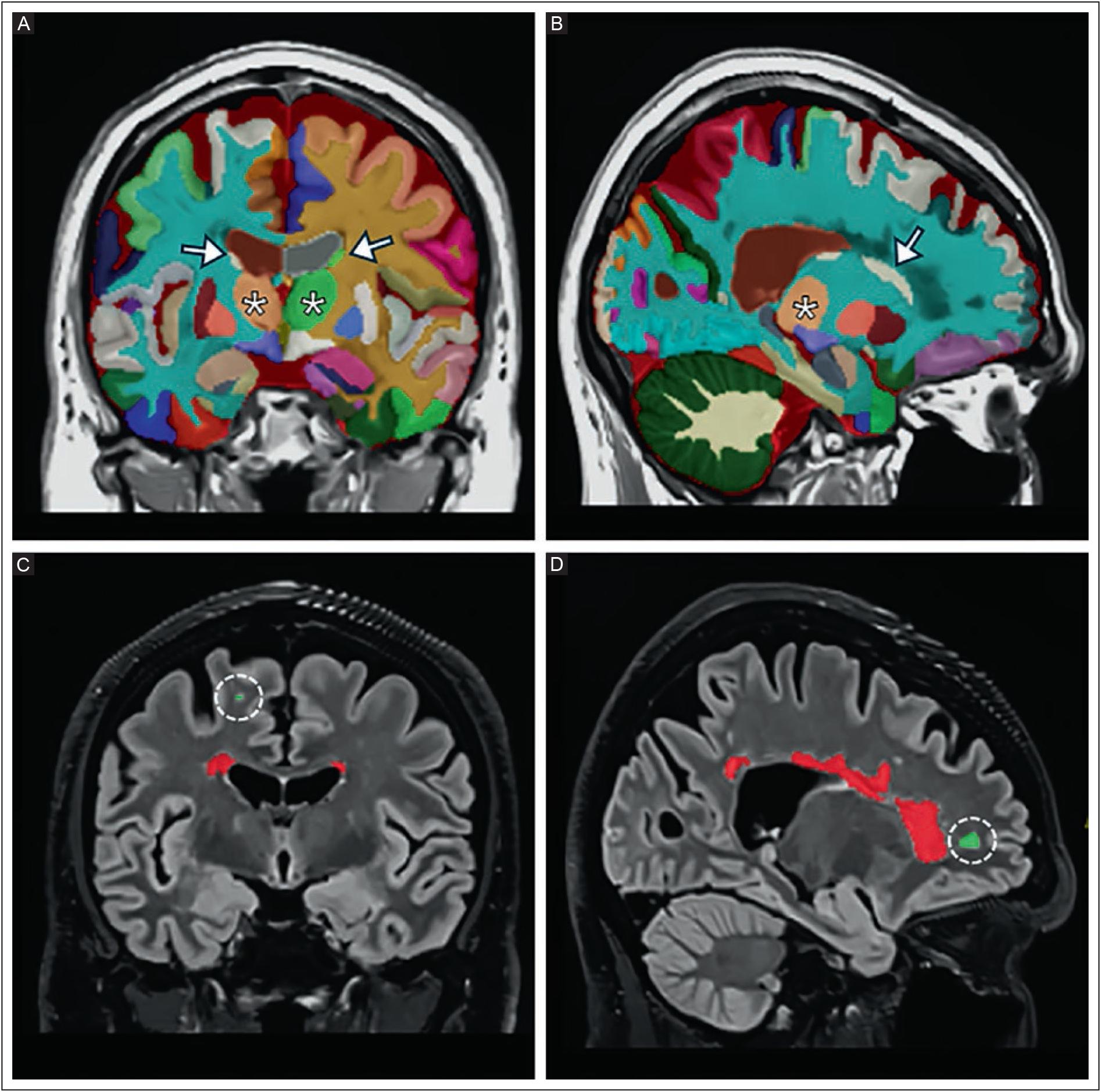 Thalamic atrophy correlates with white matter lesion metrics in Mexican ...