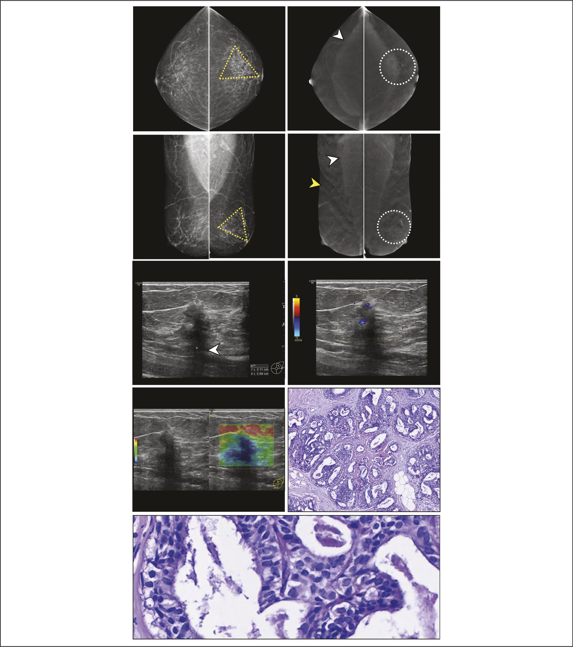 Bi Rads Cem Standardized structured breast CEM report based on BI-RADS v2025: a ...