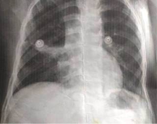 
						Telerradiografía de tórax: presenta una imagen que incrementa la densidad pulmonar en el lóbulo medio caracterizada por un patrón de consolidación con broncograma aéreo y signo de silueta positivo, sugerentes de una atelectasia pulmonar.
					