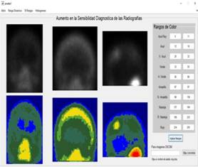 Software to assist in the interpretation of bone scans