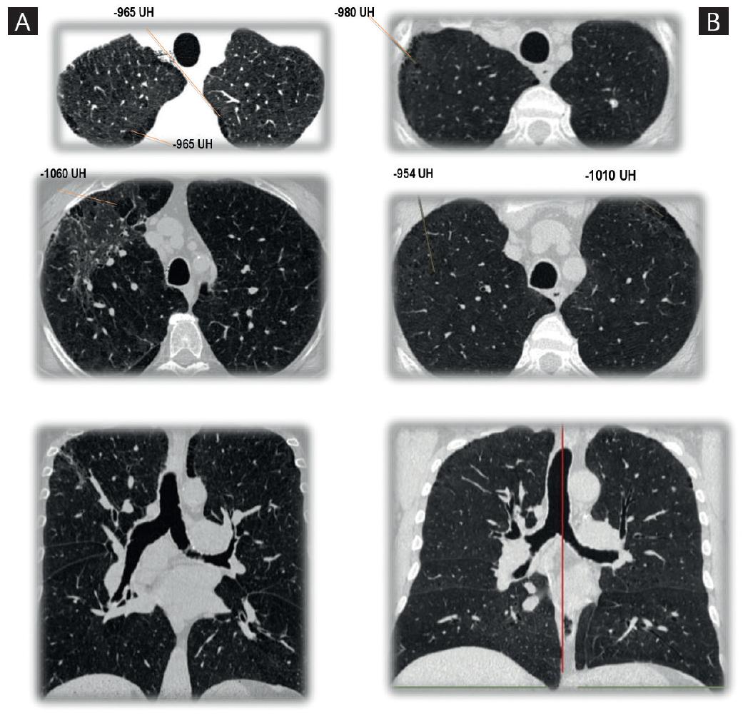 Emphysema Diagnosis Ct Scan