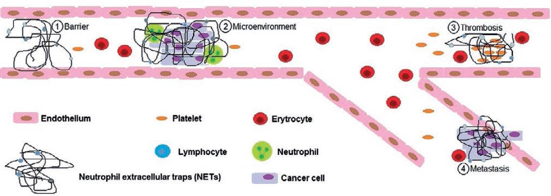 Could Neutrophil Extracellular Traps Be the New Prognostic Markers of ...