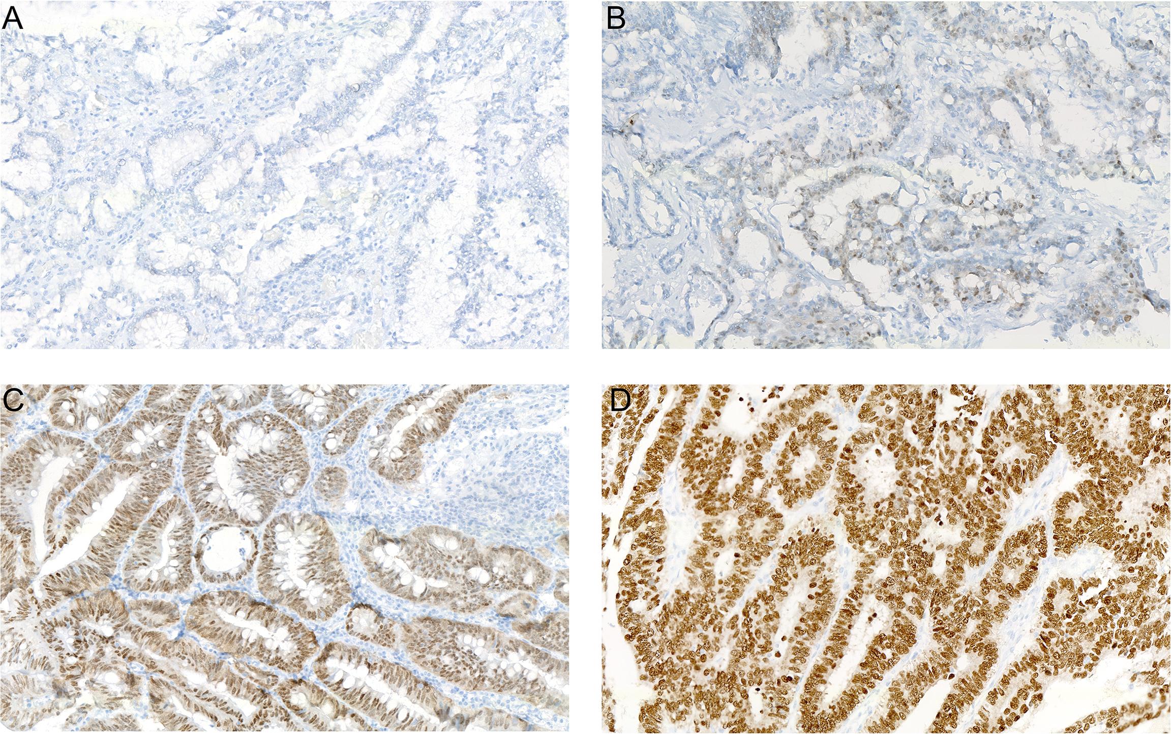 Multivariate Prognostic Models for Patients with Stages I and Ii Colon ...