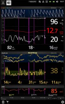 Sedline Monitor Waveforms Presentación de un caso y revisión de literatura: anestesia total ...