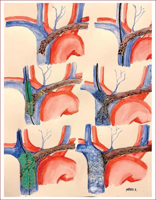 Misposition Iatrogenic superior vena cava syndrome: Description of an endovascular ...