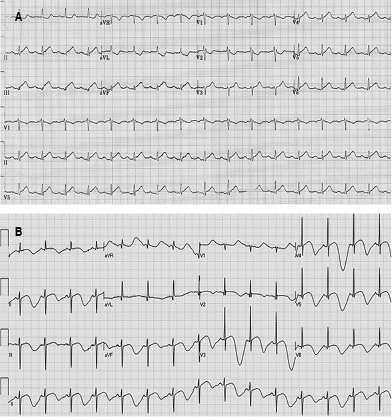 
						A 12-lead electrocardiogram in sinus rhythm with heart rate of 100 beats per minute, ST segment elevation of 0.2 mV in DII, DIII, aVF and V4-V6, suggestive of inferolateral acute ST segment elevation myocardial infarction (A). Electrocardiographic monitoring after 48 hours with presence of deep T wave inversion and asymmetric branches in DII, DIII, aVF and V3-V6 (B).
					