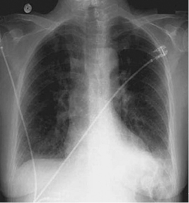 
						Chest X-ray in anteroposterior projection with increased bilateral vascular pattern, without apparent cardiomegaly, no other visible changes.
					