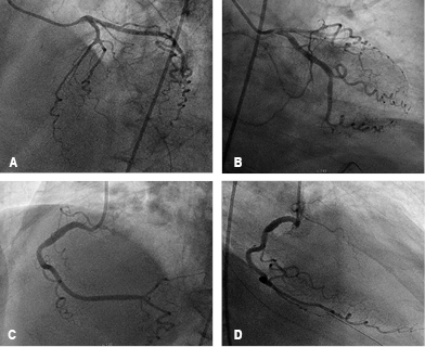 
						Diagnostic coronary angiogram, which is reported without significant angiographic lesions with normal distal flow in both the left system (A and B) and right coronary system (C and D).
					