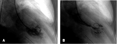 
						Left ventriculography in right anterior oblique projection in which the characteristic deformation of STK in diastole (A) and more pronounced in systole (B) is observed.
					