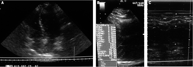 
						Transthoracic echocardiogram of three months after discharge, in 4-chamber axis projection, the left ventricle shows no alterations in morphology during relaxation (A), without chamber enlargement, left ventricular ejection fraction preserved displayed by Teichholz (B), and adequate ventricular mobility by M mode (C).
					