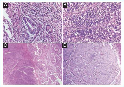 
                    Histological sections stained with hematoxylin-eosin were observed in two
                        of the 23 cases studied. A: Some glandular structures are
                        identified in some fields (×20) 2: Diffuse growth pattern in poorly
                        differentiated adenocarcinoma (×40). B-D: The morphological
                        characteristics of poorly differentiated adenocarcinomas are shown.
                