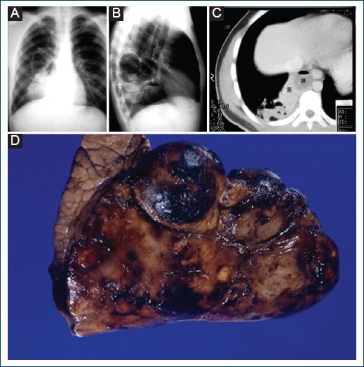 Heterogeneous Opacity Benign cystic adenomatoid malformation: A case report and literature review