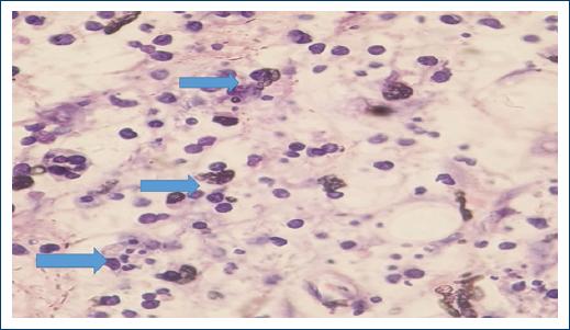 Intestinal histoplasmosis in immunocompetent patient: An unusual cause ...