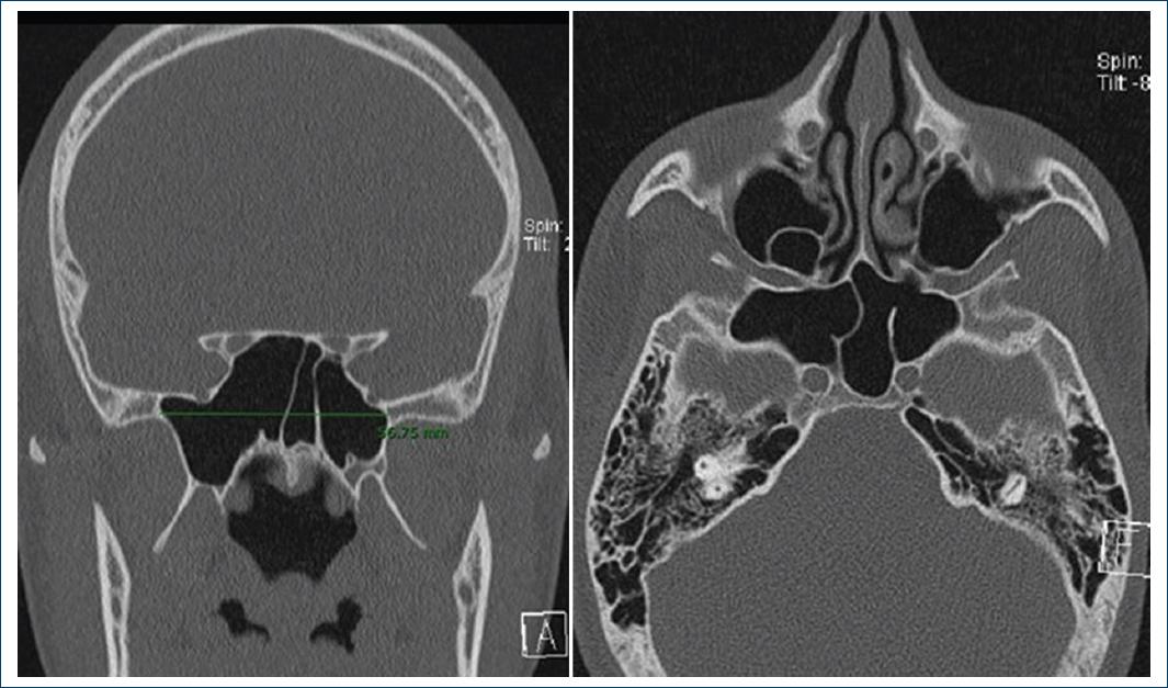 Tomographic classification proposal for safe endoscopic surgery of the ...
