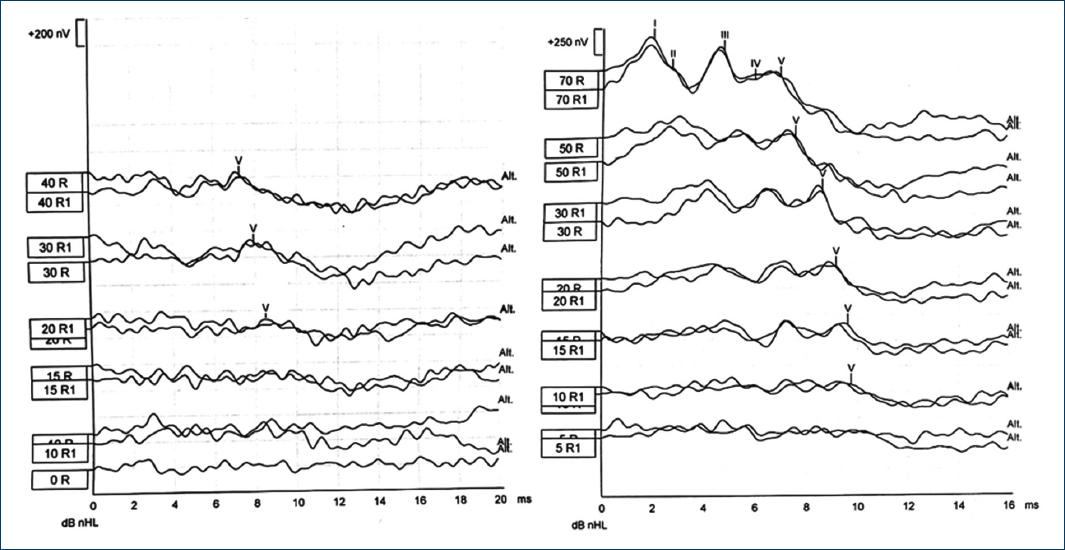 Auditory brainstem response thresholds difference using Click and CE ...