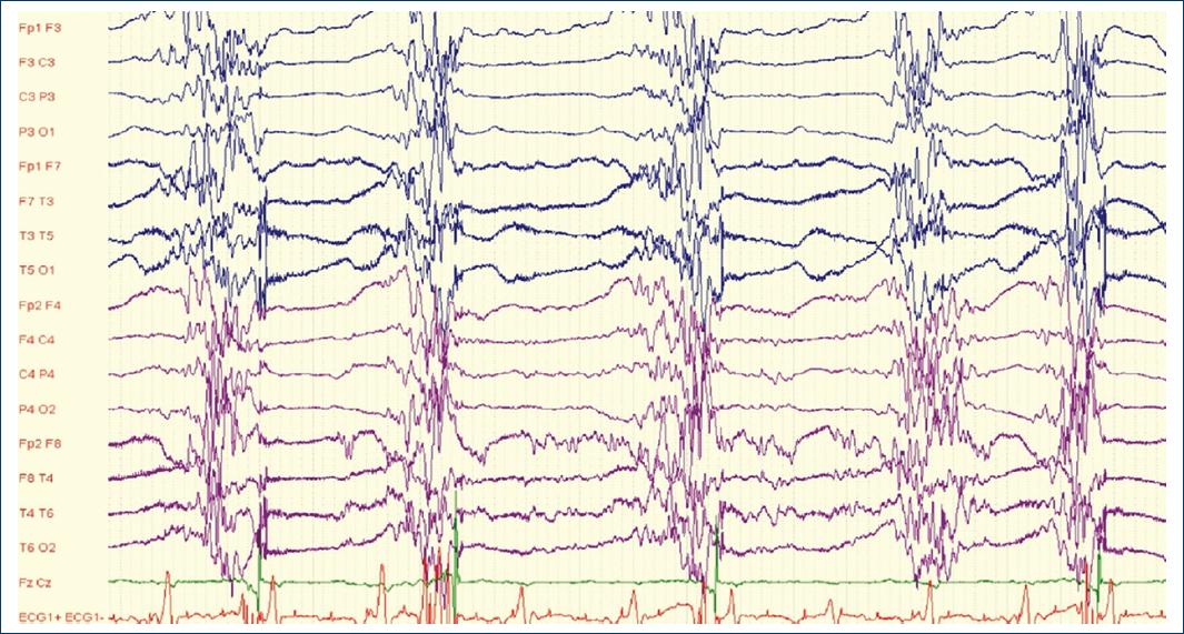 Hypoxic-ischemic brain injury: literature review