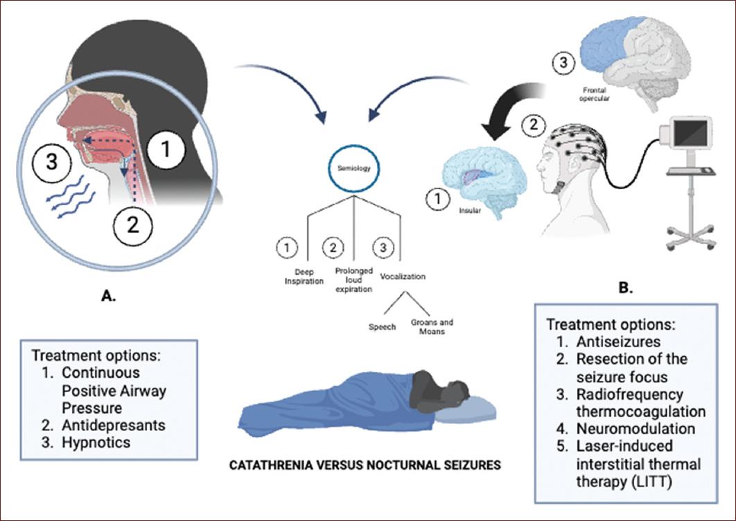 Nocturnal frontal opercular seizures masquerading as catathrenia: a ...