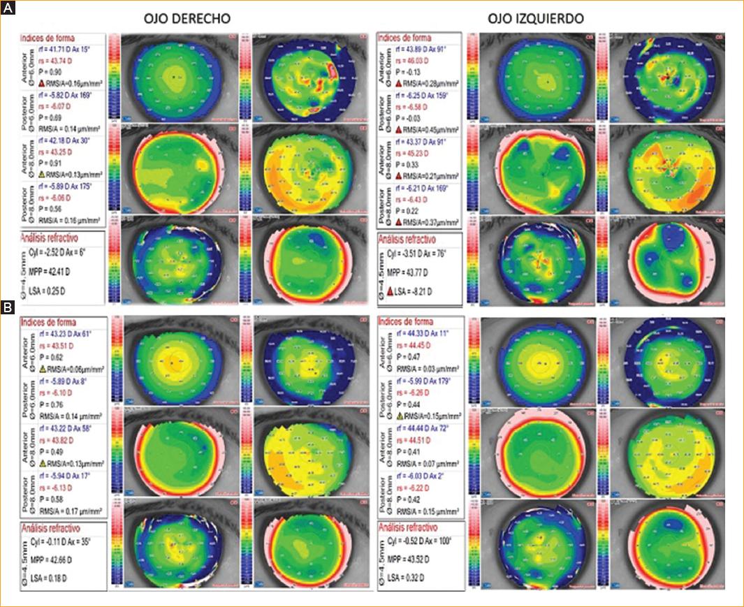 Distrofia Corneal Clasificaci n Y Queratectom a Fototerap utica Distrofia corneal clasificaci n y queratectom a fototerap utica