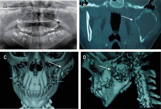 quiste-seo-simple-a-nivel-de-rama-mandibular-con-caracter-sticas-at-picas