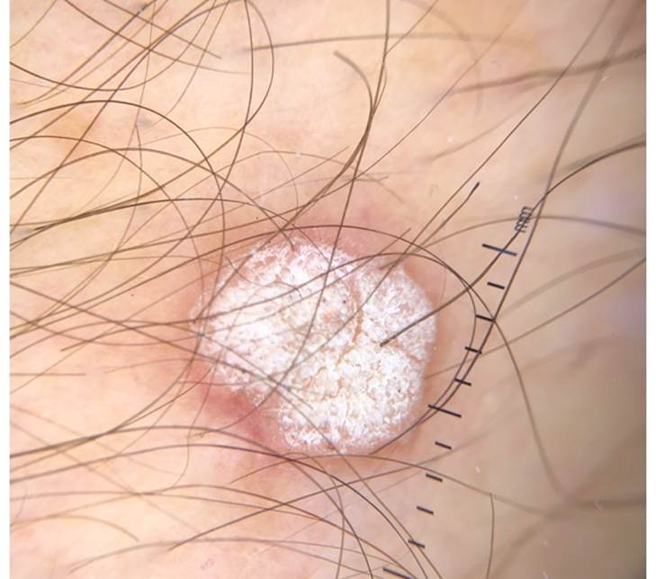 
							Dermatoscopia de verruga viral. Verrugosidad ovalada, superficie queratósica de 5 mm de diámetro, con vasos puntiformes.
						