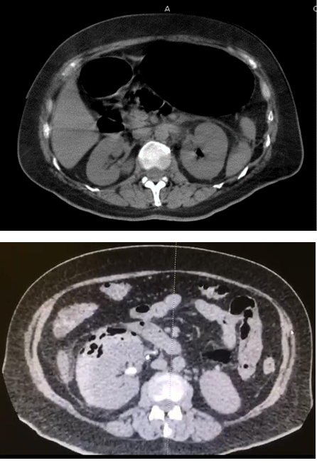 pielonefritis-enfisematosa-revisi-n-de-la-fisiopatolog-a-y-tratamiento