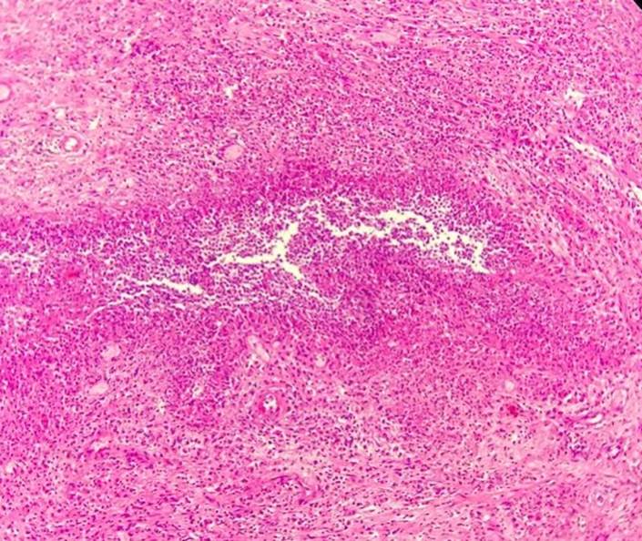 Presentación de reporte de caso: Estallido renal espontaneo por ...