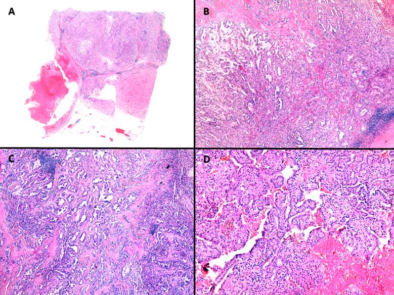 Carcinoma Renal De Ductos Colectores De Bellini Presentaci n De Dos 