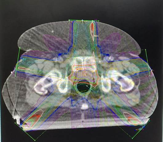 PET-CT 18F-PSMA 1007 in the staging of patients with prostate cancer ...