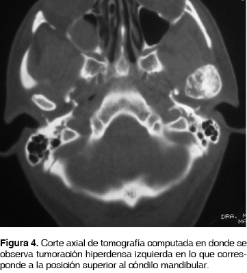 Modelo de maxilar y mandíbula afectada por un pecoma_01 - AJL