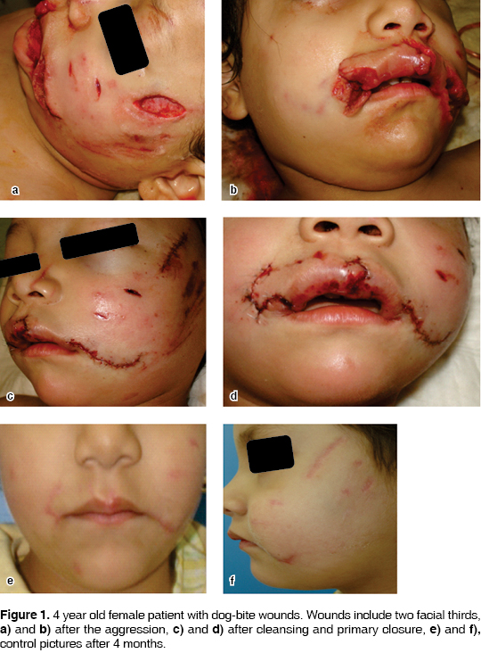Treatment of craniofacial region wounds caused by dog bite