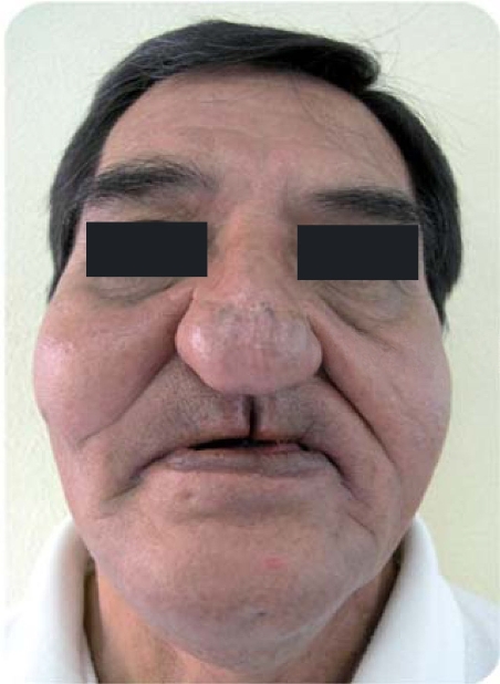 
							Facial collapse of middle third of the face.
						