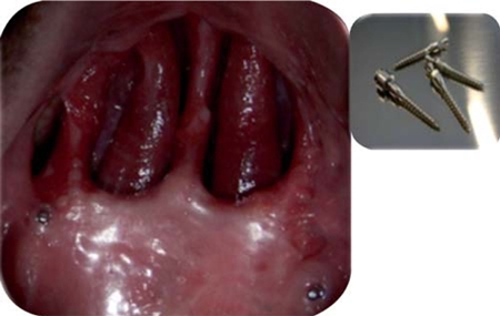 
							Mini- implants in place.
						