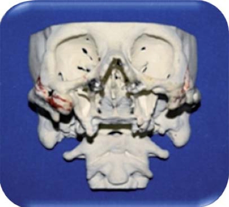 
							Stereolithograph used for pre-surgical analysis.
						