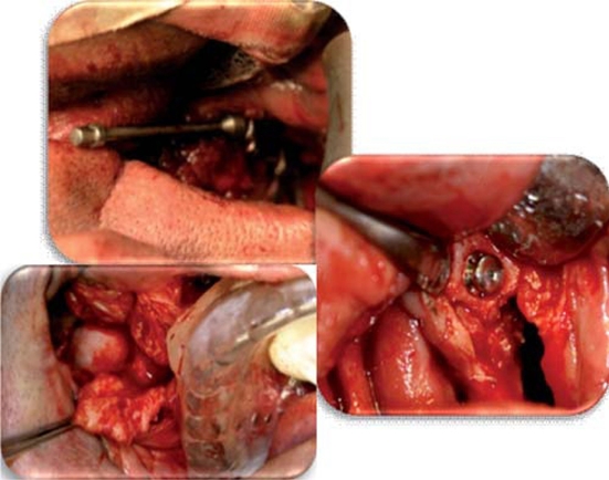 
							Surgical procedure: placement of bone distractors and zygomatic implants.
						