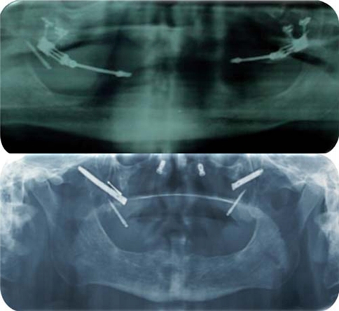 
							Follow-up with orthopantomographies of bone distractors and placed implants.
						