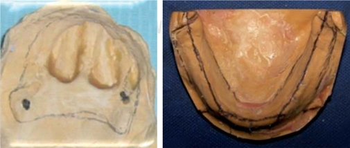 
							Upper and lower study models.
						