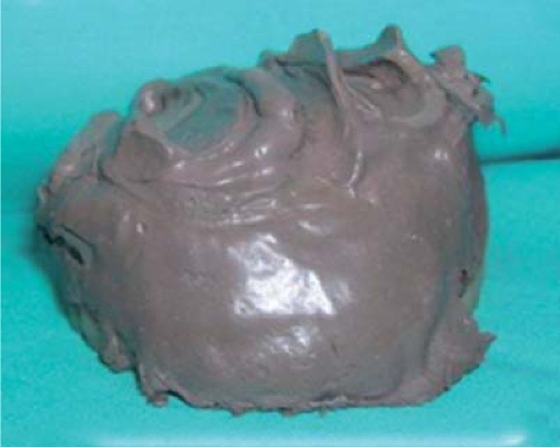 
							Physiological impression with polysulfide rubber.
						