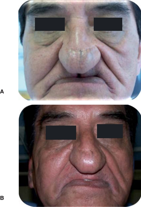 
							Before (A) and after (B) denture placement (first result).
						