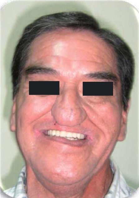 
							Final denture (second result).
						