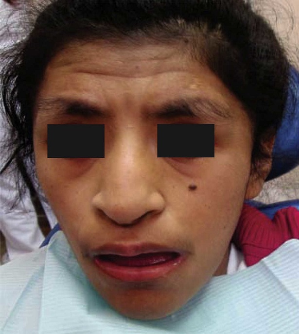 Día del Síndrome de Rubinstein-Taybi – ASOCIACION MEXICANA DE PEDIATRIA