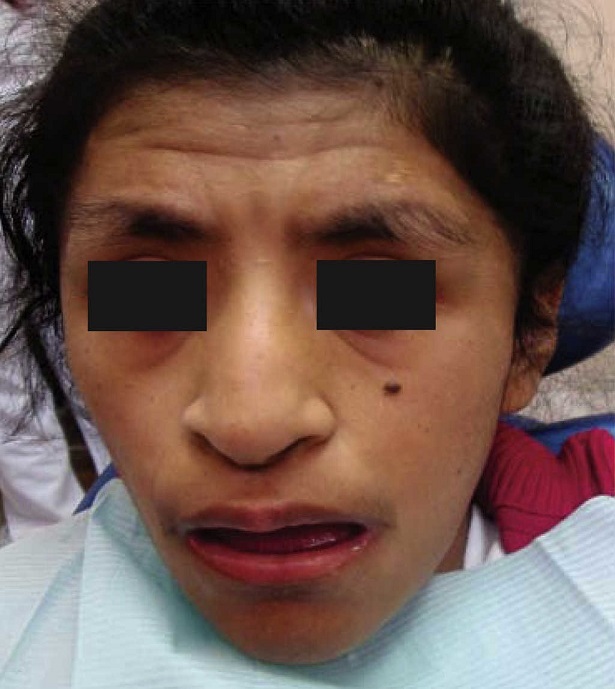 Rubinstein-Taybi Syndrome: A Rare Case Report