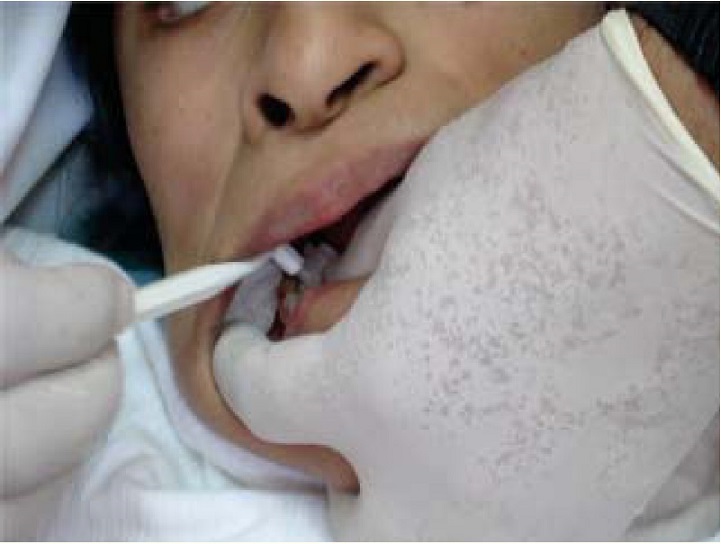 PDF) Rubinstein-Taybi syndrome: Dental manifestations and management
